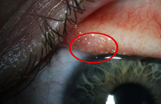 Gözlerinden tam 14 tane solucan çıktı!