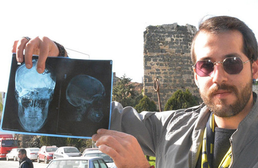 26 yıldır beynindeki dişle yaşıyor