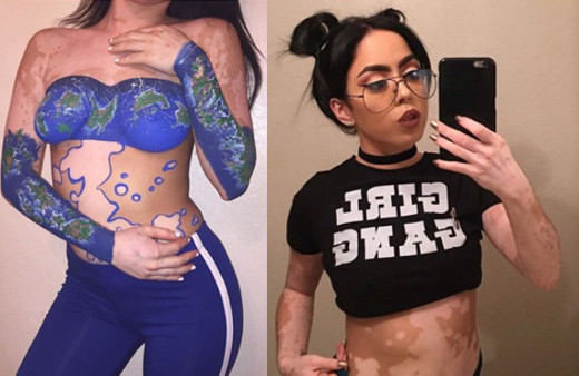 Görenler hayrete düşüyor! Hastalığını sanata çevirdi