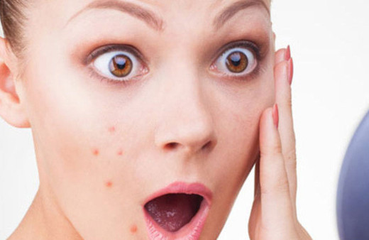 Sivilce izleriniz nasıl geçer işte cevabı...