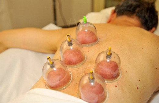 Hacamat hangi günlerde yapılır? Hacamat nerelere nasıl yapılır? 