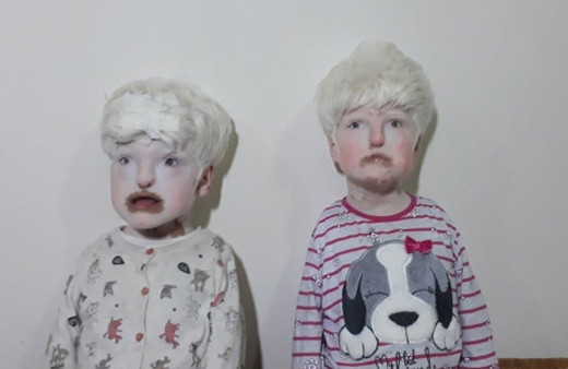 Albino kardeşler yardım bekliyor! 