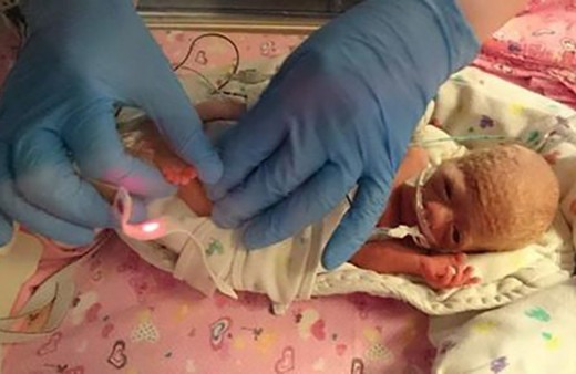 500 gramda doğdu 1 saat yaşamaz denildi son haline bakın