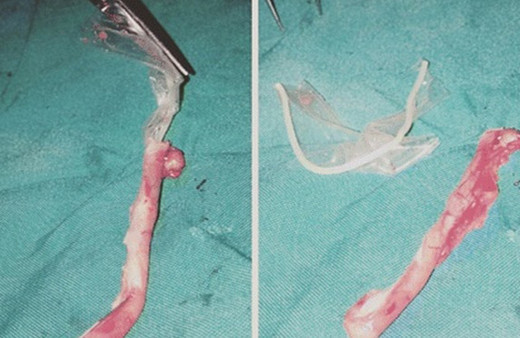 6 ay boyunca öksürük ateş dinmedi akciğerinden prezervatif çıktı!