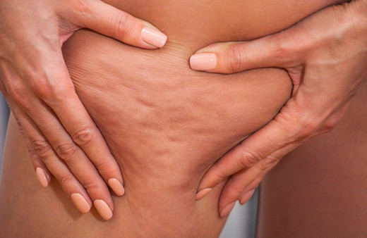 Selülit nasıl geçer? Selülit masajı ile selülitlerden kurtulun