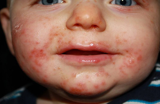 Anne babalar bu salgına dikkat!