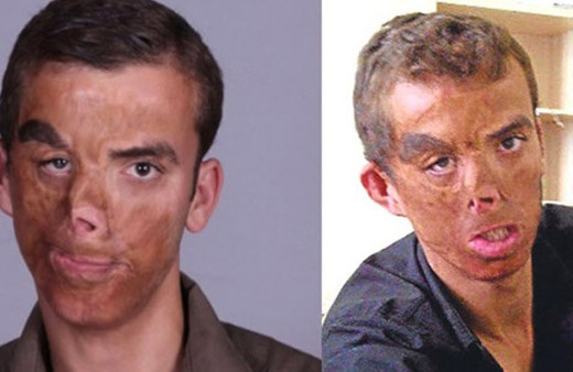 Türkiye'nin ilk yüz nakliydi! Uğur Acar'ın son hali görenleri şaşkına çevirdi