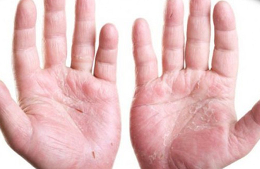 Uzmanlar uyardı egzama kalp hastalıklarını tetikleyebilir 