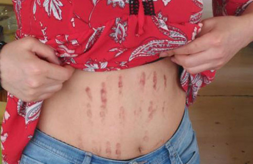 Dövülmedi! Yaptırdığı lazer epilasyon bu hale getirdi