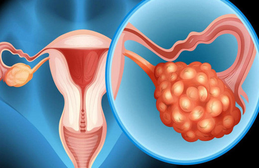 Yumurtalık kanseri belirtilerine dikkat! Yumurtalık kanseri neden olur? 