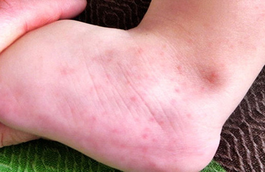 Ayakta kırmızı lekeler neden olur, hastalık belirtisi mi?
