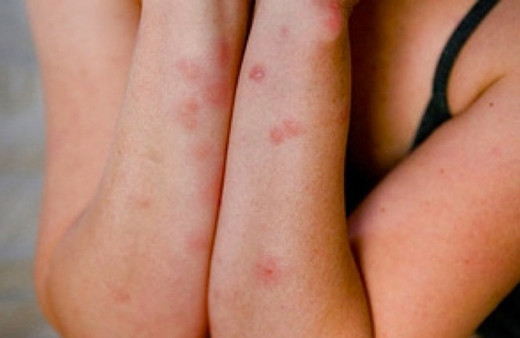 Bu böcek ısırıklarına dikkat! Hangileri tehlikeli