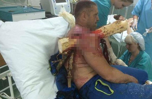 Dehşete düşüren manzara! Omzuna kütük saplandı