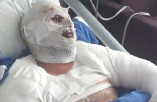 Saç kurutma makinesini çalıştırdı, patlamada bu hale geldi