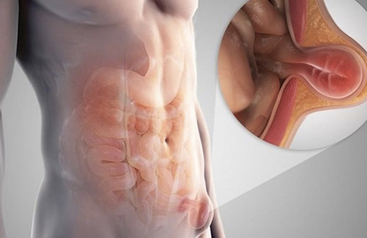 Kasık fıtığı nasıl olur Adnan Oktar hastalığı-kediciklerle cinsel ilişki....