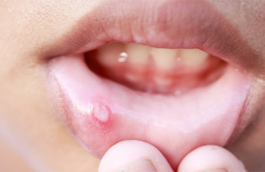 Aft nasıl geçer karbonat ve sumak ile en etkili doğal aft tedavisi