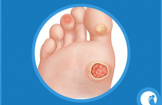 Nasır neden oluşur?