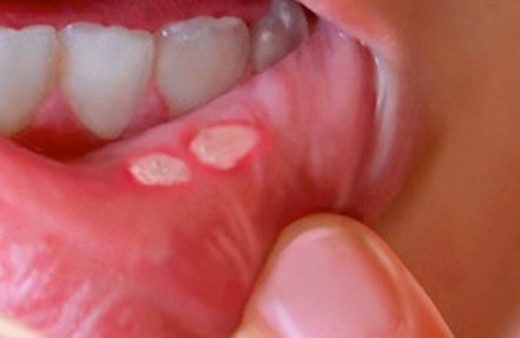 Ağız yarası Aft neden olur ilaç çare değil afta ne iyi gelir