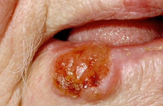 Ağız kanseri belirtileri neler tedavisi sonuç veriyor mu? 