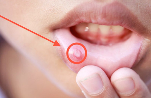 Aft Nasıl Geçer tuz karbonat sumak ile ağız yarası aft tedavisi