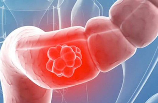 Bağırsak kanseri evreleri 4. evre nedir ameliyat tedavisi çare mi?