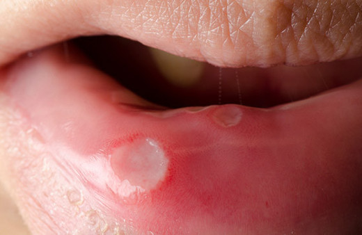 Aft bulaşıcı mı ağız yarası aft hangi vitamin eksikliğinde olur? 