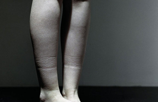 Çorap giydiğinizde bu iz çıkıyorsa dikkat o kadar masum değil!