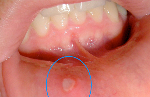 Aft için doğal çözüm! Ağız yarası aftı geçiren Saraoğlu tedavisi