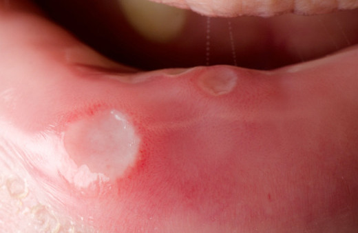 Aft ne zaman tehlikeli ağız yarası için hangi doktora gidilmeli?