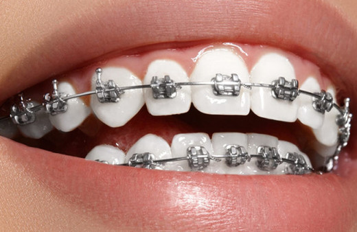 Diş teli kullananlar için ağız bakım önerileri...