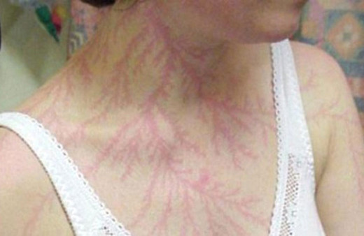 Yıldırımın çarptığı insana ne olur?