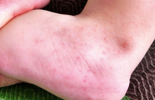 Ayakta görülen lekeler kırmızı lekeler ayakta neden olur