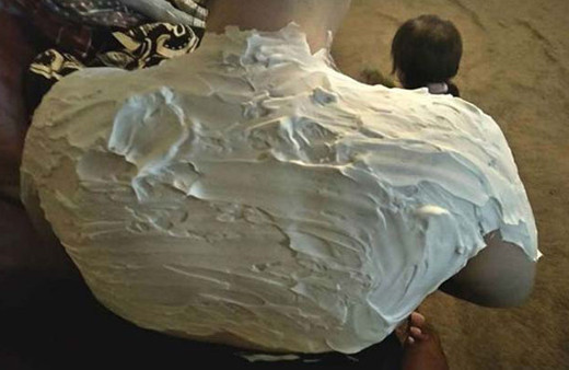 Sırtına tıraş köpüğü sürdü: Acılardan kurtuldu!