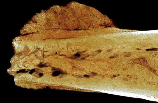 İnsanlık tarihindeki en eski kanser vakası