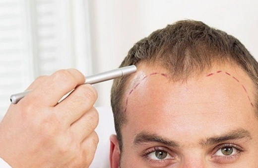 Saç ekim işlemi kimlere yapılır?