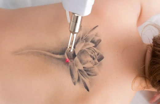 Dövme sildirme yöntemleri nelerdir?