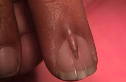 Tırnağının üstünde tırnak çıktı