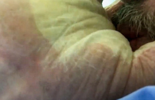 Alerji sonrası elini balon gibi şişirdi