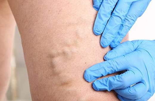 Varis oluşumu belirtileri nelerdir?