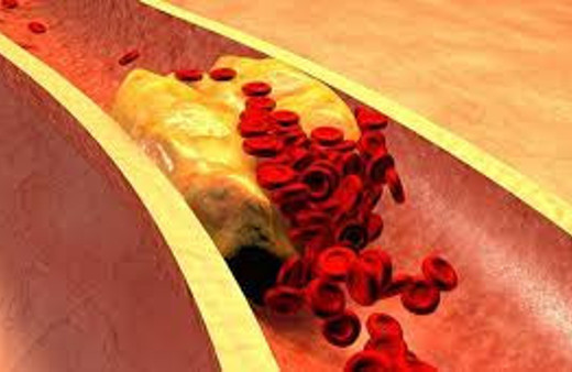 Damar tıkanıklığını tetikleyen durumlar nelerdir?