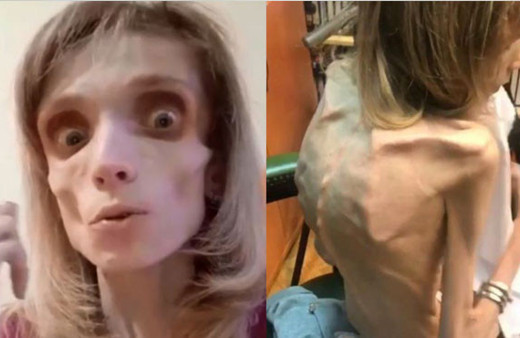 Bu kadın sadece 17 kilo! Doktoru "Korku filminde ceset rolü oynarsın" dedi