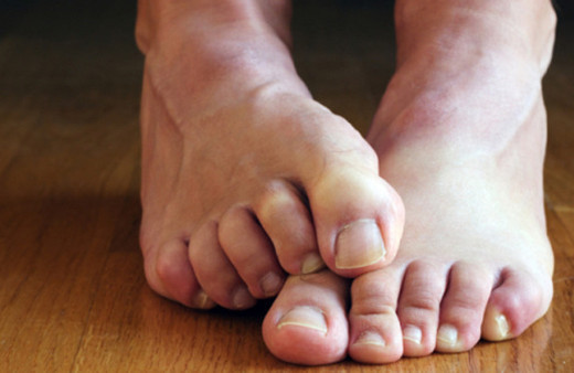 Ayak mantarı başı çekiyor işte ayaklarda sık görülen 4 cilt hastalığı!