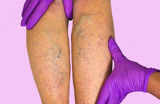 Varis nedir, belirti ve tedavi yöntemleri nelerdir?