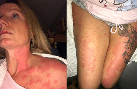 Alkol yüzünden hayatı karardı! Vücudunda yanmayan yer kalmadı