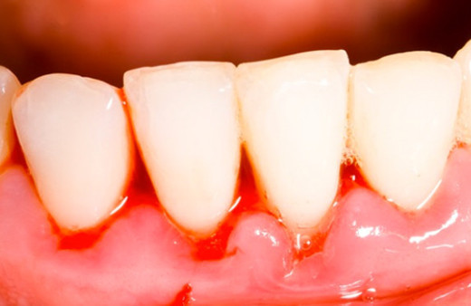 Diş eti problemleri nelerdir Lamina tedavisi nedir?