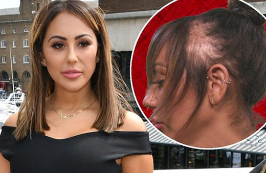 Güzel modeller kel kalmanın eşiğinde