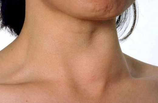 Guatr nedir? İşte belirtileri ve tedavi yöntemleri