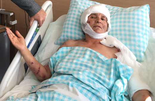 9 köpek saldırdı kafasındaki saç derisinin üçte ikisi yok