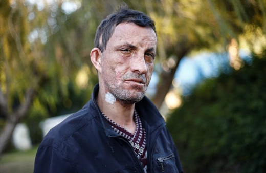 7 yıl geçti! Türkiye'nin ilk yüz nakli olan Uğur Acar'ın son haline bakın