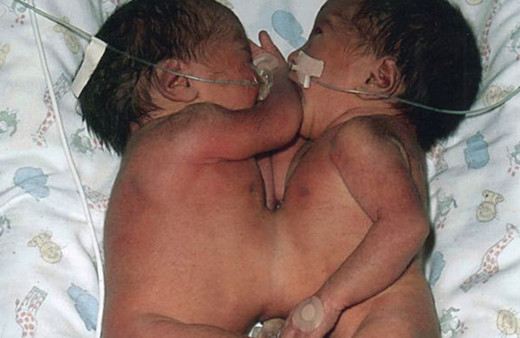 Doktorların yaşamaz dediği mucize ikizler 16 yaşına girdi